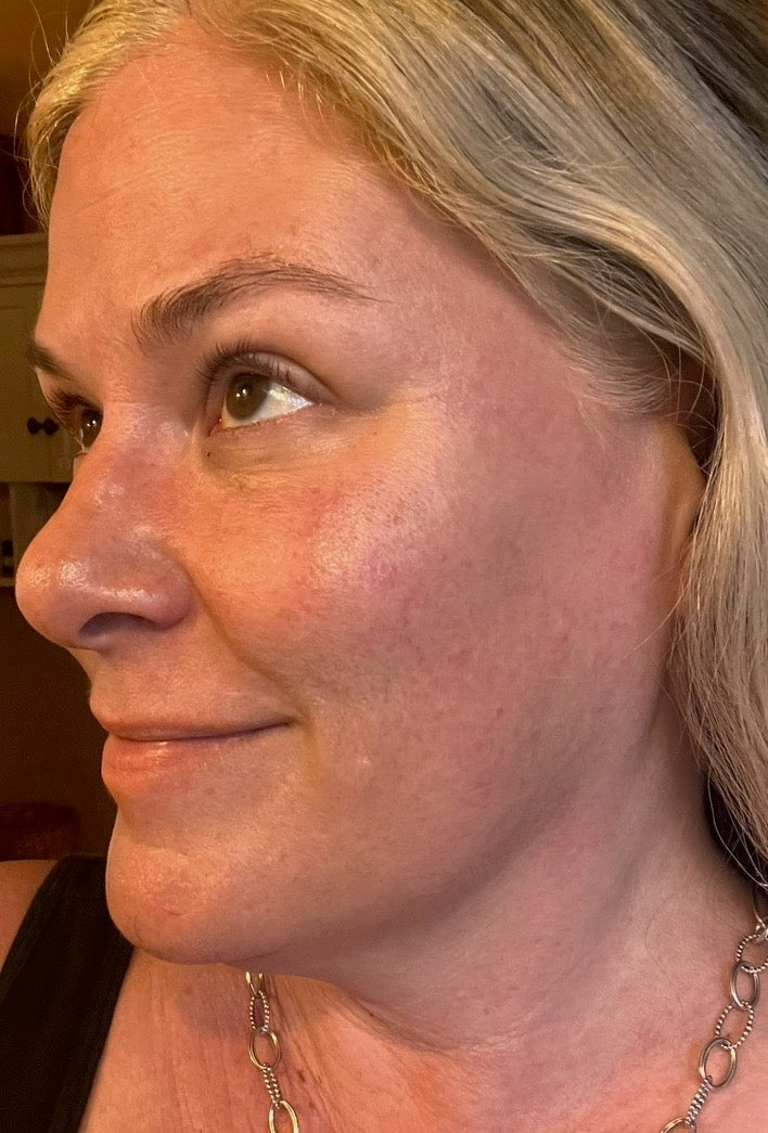close up of female skin after using Pure Blossom Skin for 120 days. Much less redness, less discoloration, and much more even color and glow.