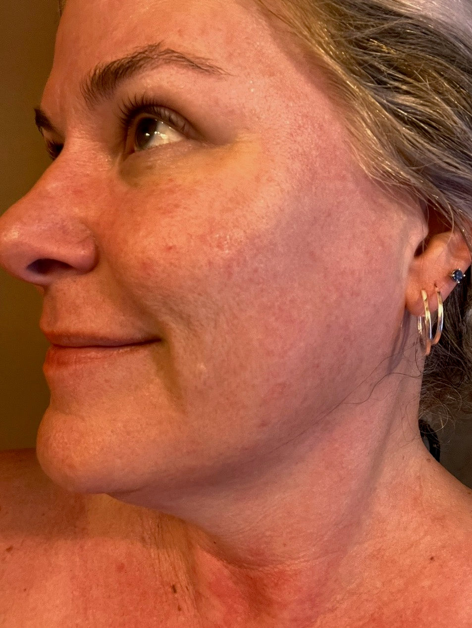 Close up of female skin showing redness and discoloration